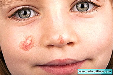 Lastel angioma: miks need tekivad ja kuidas seda tüüpi nahalaike ravitakse