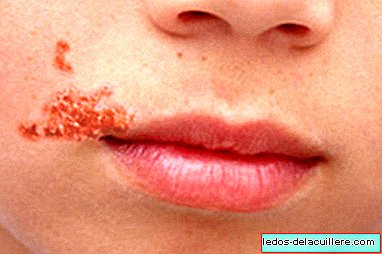 Impetigo outbreak in schools in Barcelona: all about this very contagious skin infection