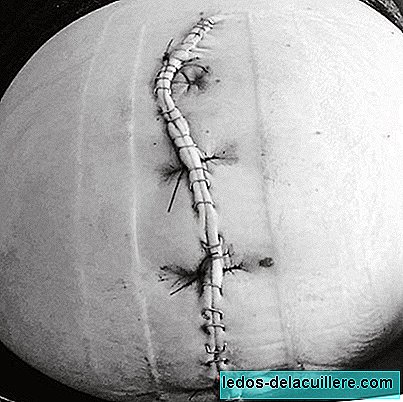 Proudly share the vertical scar of her caesarean section that allowed her baby to be born
