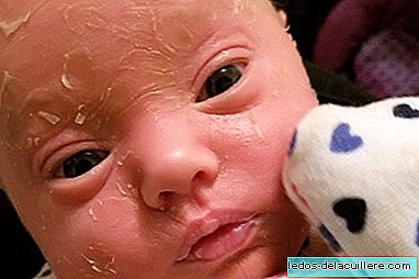 الحالة الغريبة لأميليا ، الطفلة الصغيرة المصابة بالسمك الصفحي والتي تشبه جلدها قشور السمكة
