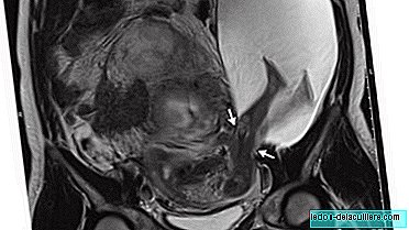 The incredible pregnancy of a baby who went through the uterus with his legs