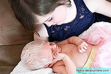 "Det er en snøfe": den ømme reaksjonen fra en fem år gammel jente på å møte søsteren sin med veldig albinisme