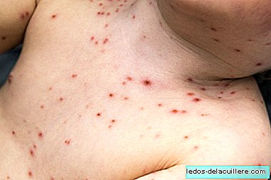 Spain achieves measles-free country accreditation