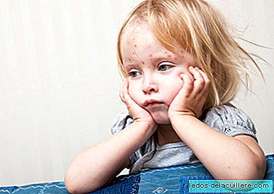 Fête de la varicelle: il est très dangereux de faire transmettre la maladie aux enfants au lieu de les vacciner