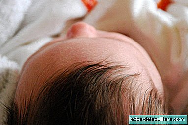 Hipertricose ou "síndrome do lobisomem": afeta bebês e crianças