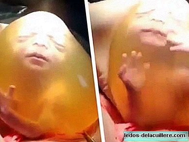 Impressive birth by caesarean section in which the baby leaves inside the amniotic bag