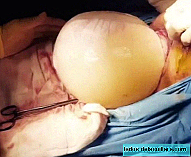 Amazing video of a baby born inside the amniotic caesarean section