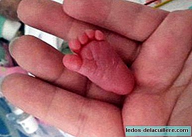The smallest baby in history: she weighed 225 grams at birth and her foot was practically like a nail