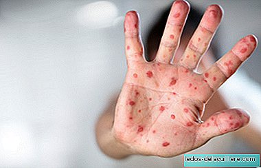 WHO warns that measles cases in the world have skyrocketed to historical figures