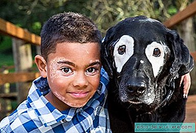 The precious story of a child with vitiligo and a dog united by the same disease