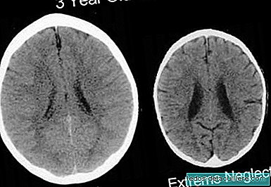The terrible image that shows what happens to a baby's brain when nobody cares