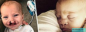 Une fente labiale chez le bébé peut-elle être évitée?