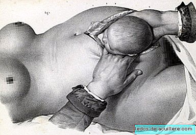 The two incredible illustrations that show how caesarean sections were performed when operated without anesthesia