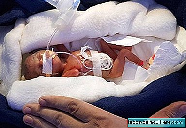 He came to the world with 400 grams and managed to survive despite being born a girl in India