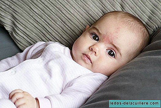 البقع المتكررة والجرانيت والوحمات على جلد الأطفال حديثي الولادة