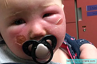 Be very careful with what you apply to your baby: her 14-month-old daughter suffers burns on her face due to a sun spray