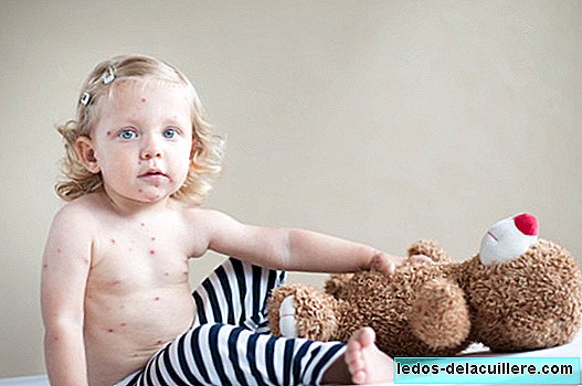 Um menino de 4 anos morre de uma complicação derivada da varicela