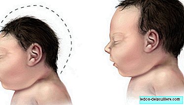 לא כל התינוקות של אמהות שנדבקו בזיקה נולדים עם מיקרוצפלציה