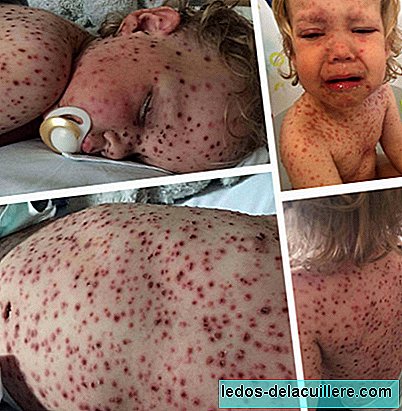 Another mother shares the chickenpox reaction in her son and asks that all children be vaccinated
