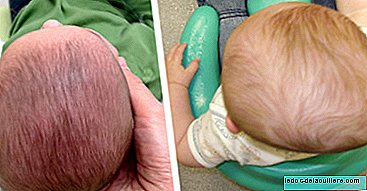 Plagiocefalija: Kako preprečiti in zdraviti vse pogostejšo deformacijo glave dojenčkov?