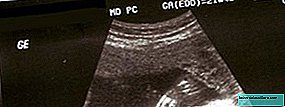 Tehotenské testy: meranie nugálneho záhybu