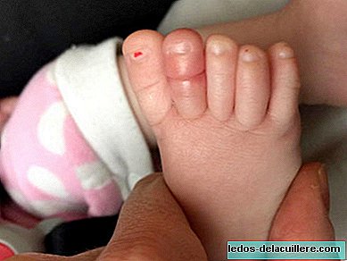Syndrome de tourniquet chez le bébé: œil avec des fils et des poils