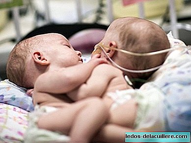 Séparez avec succès deux bébés siamois de 13 mois unis par la poitrine et l'abdomen