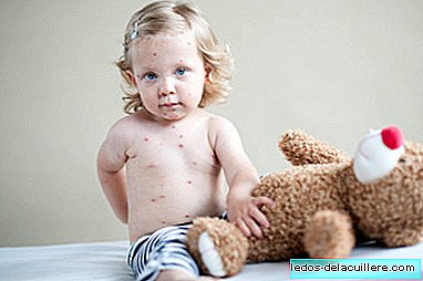 طفل غير مصاب يبلغ من العمر 20 شهرًا يحصل على الحصبة في إقليم الباسك