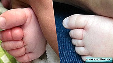 A mother alerts about "tourniquet syndrome" after her baby is about to lose her toes