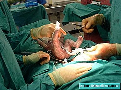 Brazil, the country with the most caesarean sections in the world