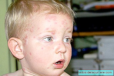 Where is the chickenpox vaccine?