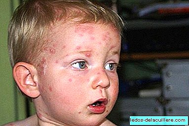 La pénurie de vaccins contre la varicelle n'est due à aucune raison d'innocuité ni à un manque d'efficacité de cette vaccination