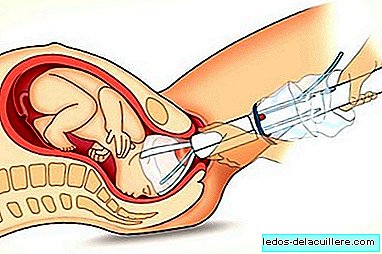 The Odón device: to give birth like a cork from a bottle