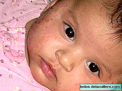 Bệnh chàm ở trẻ em làm tăng gấp bốn lần nguy cơ mắc bệnh hen suyễn và viêm mũi dị ứng