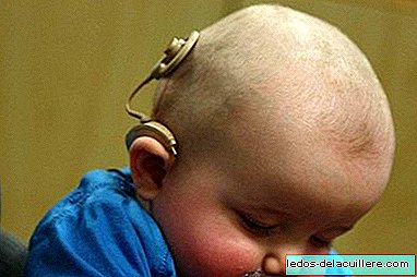 Cochlear implantaat: kenmerken