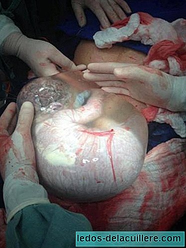 Impressive: the photo of the baby born with the intact amniotic sac