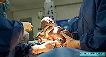 Cesarean section on video, step by step