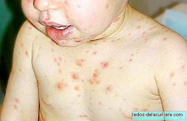 Tuulerõugete vaktsiin vähendab riski haigestuda imikutele, keda ei saa vaktsineerida