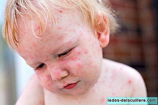 The chickenpox vaccine will be given in 2016, but the OCU is positioned against: what to do?