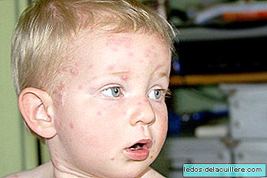 Chickenpox in children: everything you need to know
