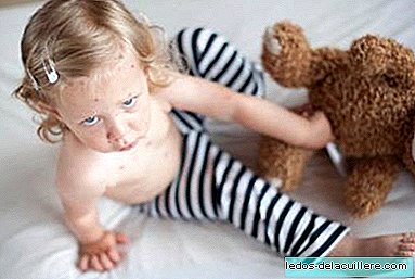 More cases of chickenpox in children and with greater complications