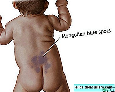 My son has a spot on his back and buttocks: the Mongolian spot