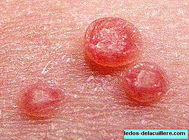 Moluscos contagiosos na pele de crianças