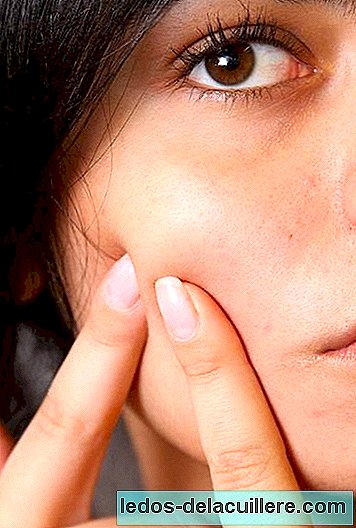 Por que eu sofro acne durante a gravidez?