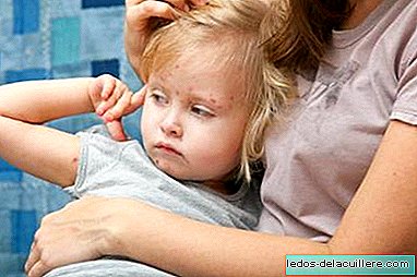 What to do if you want to give your child a chickenpox vaccine?