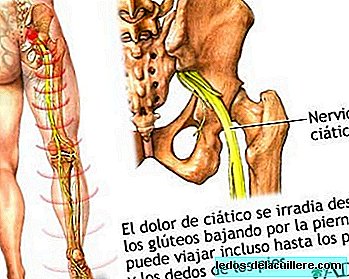 Everything about sciatica in pregnancy: how does it occur? Can it be prevented or relieved?