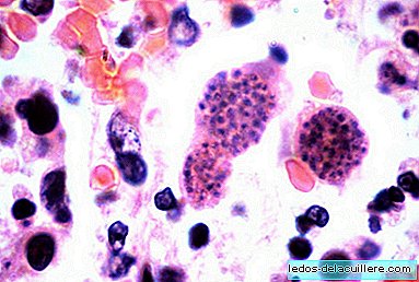 Toxoplasmosis, a headache for every pregnant woman