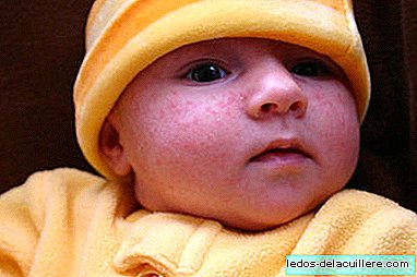 Acne in newborn babies