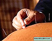 Acupuncture during childbirth