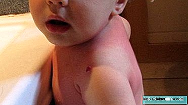 Allergies chez les bébés: urticaire et angioedème